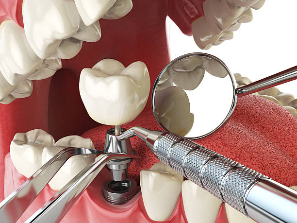 Best Broken or Cracked Tooth Emergency Dentist in Brownstown, PA